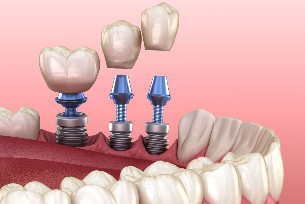 implants-dentaires implants-dentaires